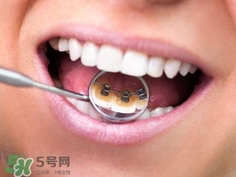 補(bǔ)牙洞需要幾次完成?補(bǔ)牙洞需要多長(zhǎng)時(shí)間? 補(bǔ)牙洞需要幾次完成?補(bǔ)牙洞需要多長(zhǎng)時(shí)間?