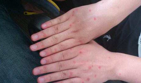 身上紅疙瘩是什么？身上紅疙瘩不痛不癢