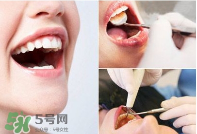 如何去掉牙結(jié)石？牙結(jié)石怎么去除
