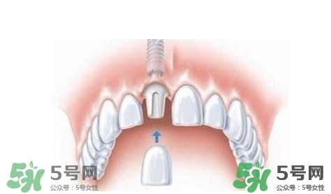牙周炎能種植牙嗎？牙周炎能不能種植牙
