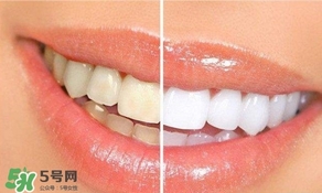 牙周炎好治嗎？牙周炎好不好治