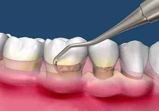 牙周炎怎么治療效果最好？牙周炎怎么治療小偏方