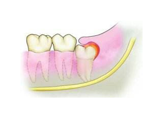 長智齒需要拔掉嗎？長了智齒一定要拔掉嗎