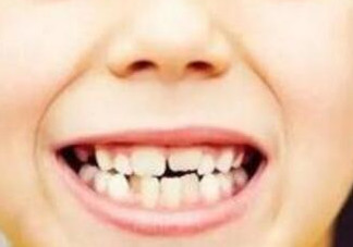 牙縫越來越大怎么辦？牙縫越來越大怎么修復(fù)