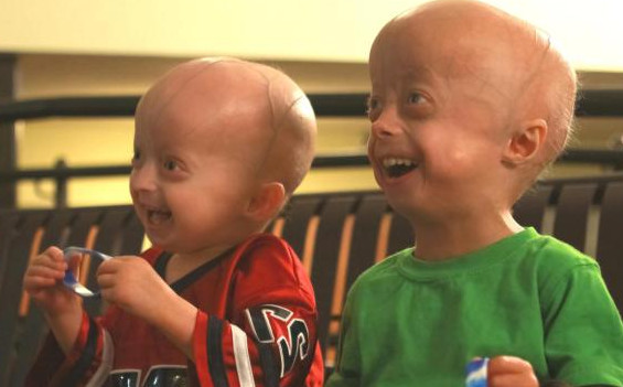 什么是早衰癥？早衰癥初期癥狀