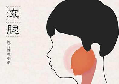 流行性腮腺炎有哪些癥狀？流行性腮腺炎的癥狀