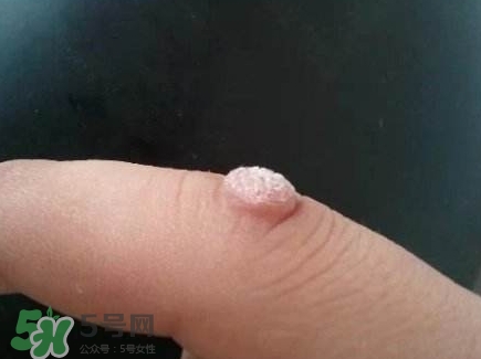 蒲公英可以治刺瘊嗎?蒲公英為什么能治瘊子? 蒲公英可以治刺瘊嗎?蒲公英為什么能治瘊子?