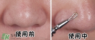 cosmos隱藏式青春痘棒粉刺針怎么樣？cosmos粉刺針多少錢？