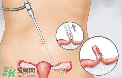 女人怎樣避孕最安全？對(duì)女人最好的避孕方法