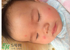 嬰兒蚊子咬了怎么消腫？嬰兒蚊子咬了怎么消腫止癢最快？