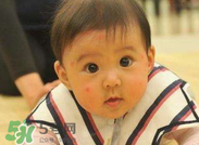 嬰兒蚊子咬了怎么消腫？嬰兒蚊子咬了怎么消腫止癢最快？