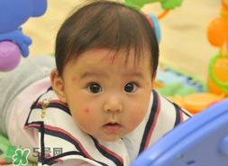 嬰兒被蚊子咬了如何去紅點(diǎn)？被蚊子咬后紅點(diǎn)如何去除？
