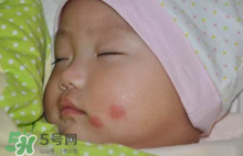 嬰兒被蚊子咬了如何去紅點(diǎn)？被蚊子咬后紅點(diǎn)如何去除？