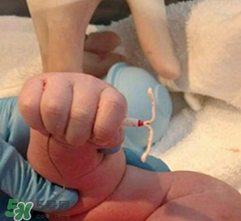 新生兒手握避孕環(huán)出生是怎么回事？出生后健康嗎？