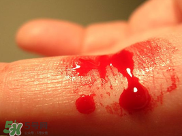 尸血會感染艾滋嗎？尸血可以治療血友病嗎？