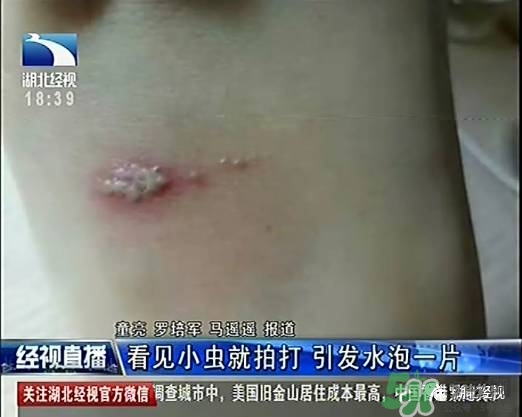 隱翅蟲有毒嗎？隱翅蟲會毀容嗎？