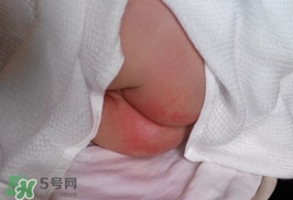 尿布疹怎么辦？寶寶尿布疹擦什么藥好？