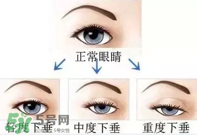 長(zhǎng)期用假睫毛雙眼皮貼對(duì)眼睛有什么傷害？