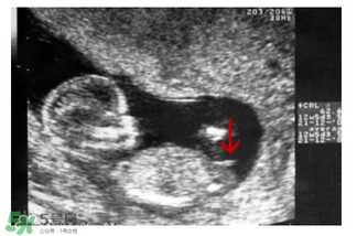 NT超圖全景看寶寶性別，親證有效的B超自測(cè)男女方法