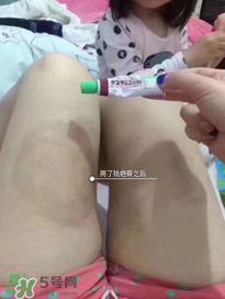 日本msd祛疤膏怎么樣？日本msd祛疤膏有用嗎？