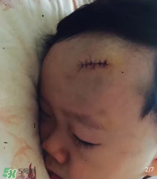 日本msd祛疤膏是抗生素嗎？日本msd祛疤膏是不是抗生素？