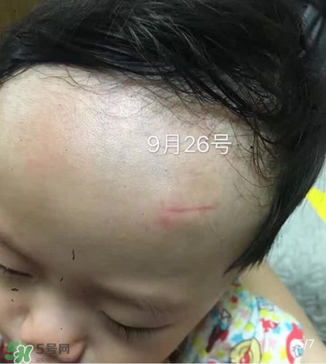 日本msd祛疤膏是抗生素嗎？日本msd祛疤膏是不是抗生素？