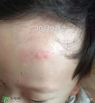 日本msd祛疤膏是抗生素嗎？日本msd祛疤膏是不是抗生素？