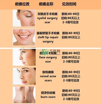 kelo cote疤痕凝膠效果好嗎？芭克硅膠軟膏效果怎樣