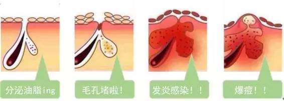 后背長痘痘是什么原因 關于后背痘痘二三事 后背長痘痘是什么原因 關于后背痘痘二三事