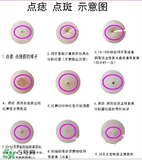 藥水點痣和激光點痣哪個好？各有什么優(yōu)缺點