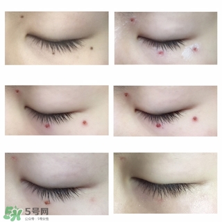 藥水點痣和激光點痣哪個好？各有什么優(yōu)缺點