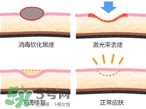 藥水點痣和激光點痣哪個好？各有什么優(yōu)缺點