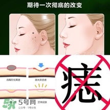 藥水點痣和激光點痣哪個好？各有什么優(yōu)缺點