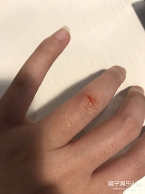 液體創(chuàng)可貼防水嗎？液體創(chuàng)可貼防水嗎透氣嗎？