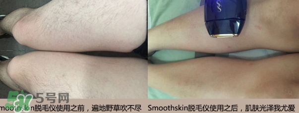 smoothskin和slikn infinity哪個(gè)好？smoothskin脫毛儀怎么樣