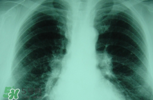 塵肺病吃什么藥能清肺？塵肺病國家有什么政策