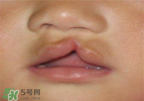 兔唇能檢查出來(lái)嗎？兔唇能完全修復(fù)嗎？