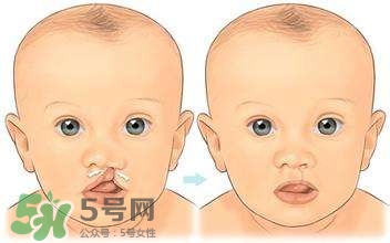 兔唇能檢查出來(lái)嗎？兔唇能完全修復(fù)嗎？