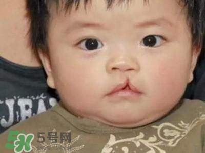 兔唇可以治嗎？兔唇修補術(shù)