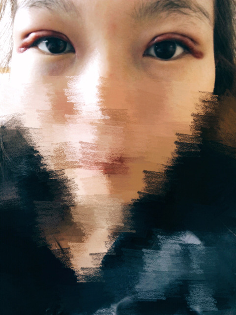 三點(diǎn)定位雙眼皮永久嗎 三點(diǎn)定位雙眼皮恢復(fù)過程圖片 三點(diǎn)定位雙眼皮永久嗎 三點(diǎn)定位雙眼皮恢復(fù)過程圖片