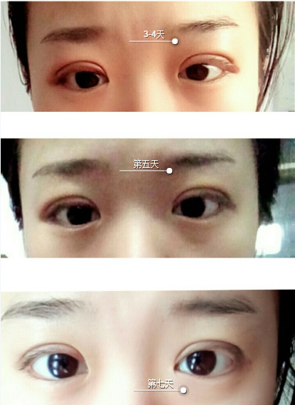三點(diǎn)定位雙眼皮永久嗎 三點(diǎn)定位雙眼皮恢復(fù)過程圖片 三點(diǎn)定位雙眼皮永久嗎 三點(diǎn)定位雙眼皮恢復(fù)過程圖片
