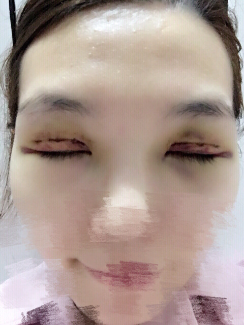 三點(diǎn)定位雙眼皮永久嗎 三點(diǎn)定位雙眼皮恢復(fù)過程圖片 三點(diǎn)定位雙眼皮永久嗎 三點(diǎn)定位雙眼皮恢復(fù)過程圖片