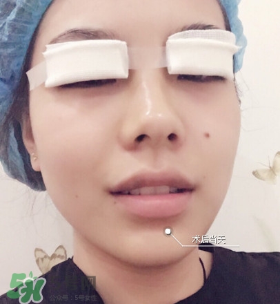 三點(diǎn)定位雙眼皮過程圖 做三點(diǎn)定位雙眼皮心得 三點(diǎn)定位雙眼皮過程圖 做三點(diǎn)定位雙眼皮心得