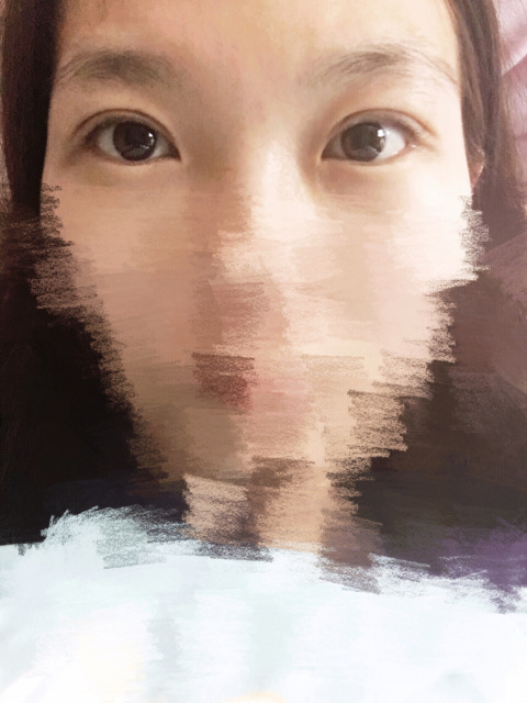 三點(diǎn)定位雙眼皮永久嗎 三點(diǎn)定位雙眼皮恢復(fù)過程圖片 三點(diǎn)定位雙眼皮永久嗎 三點(diǎn)定位雙眼皮恢復(fù)過程圖片