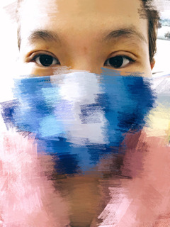 三點(diǎn)定位雙眼皮永久嗎 三點(diǎn)定位雙眼皮恢復(fù)過程圖片 三點(diǎn)定位雙眼皮永久嗎 三點(diǎn)定位雙眼皮恢復(fù)過程圖片