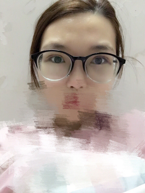 三點(diǎn)定位雙眼皮永久嗎 三點(diǎn)定位雙眼皮恢復(fù)過程圖片 三點(diǎn)定位雙眼皮永久嗎 三點(diǎn)定位雙眼皮恢復(fù)過程圖片