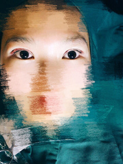 三點(diǎn)定位雙眼皮永久嗎 三點(diǎn)定位雙眼皮恢復(fù)過程圖片 三點(diǎn)定位雙眼皮永久嗎 三點(diǎn)定位雙眼皮恢復(fù)過程圖片