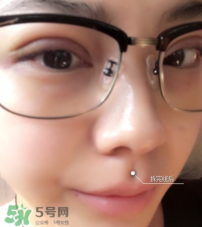 三點(diǎn)定位雙眼皮過程圖 做三點(diǎn)定位雙眼皮心得 三點(diǎn)定位雙眼皮過程圖 做三點(diǎn)定位雙眼皮心得