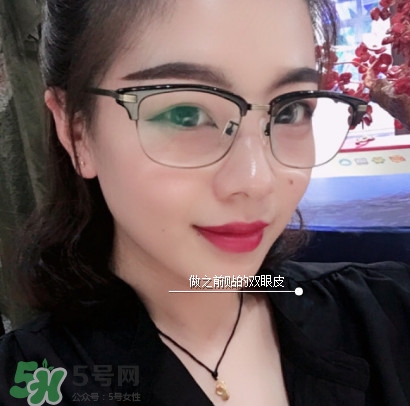 三點(diǎn)定位雙眼皮過程圖 做三點(diǎn)定位雙眼皮心得 三點(diǎn)定位雙眼皮過程圖 做三點(diǎn)定位雙眼皮心得