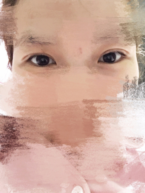 三點(diǎn)定位雙眼皮永久嗎 三點(diǎn)定位雙眼皮恢復(fù)過程圖片 三點(diǎn)定位雙眼皮永久嗎 三點(diǎn)定位雙眼皮恢復(fù)過程圖片